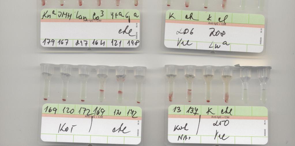 krok: absorpce, eluce a NAT Znovu jsme provedli absorpci (60 minut při 37 C) na panelové erytrocyty dárce ÚHKT fenotypu