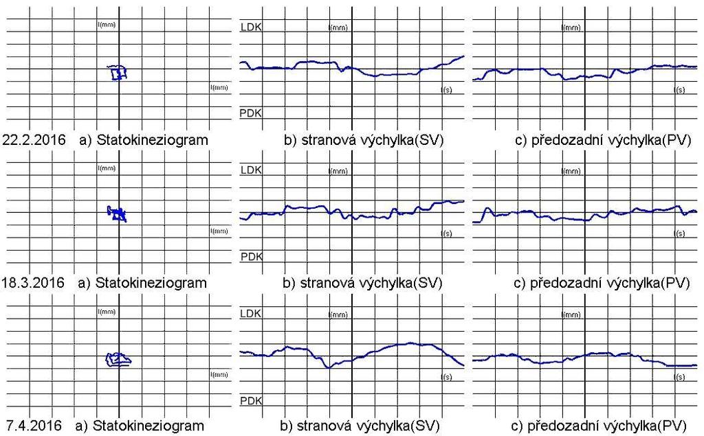 Obrázek 29 - Pacient č. 2 - Dynamická scéna - Levá spirála Tabulka 22 Pacient č. 2 Časový přehled dynamických scén (Diagnostika) Diagnostika - Pacient č. 2 1. měření (22. 2. 16) 2. měření (18. 3.