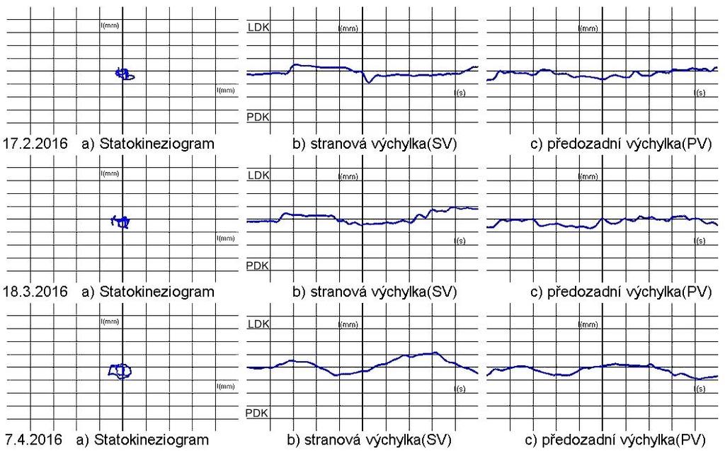 Obrázek 40 - Pacient č. 3 - Dynamická scéna - Levá spirála Tabulka 23 - Pacient č. 3 - Časový přehled dynamických scén (Diagnostika) Diagnostika - pacient č. 3 1. měření (17. 2. 16) 2. měření (18. 3. 16) 3.