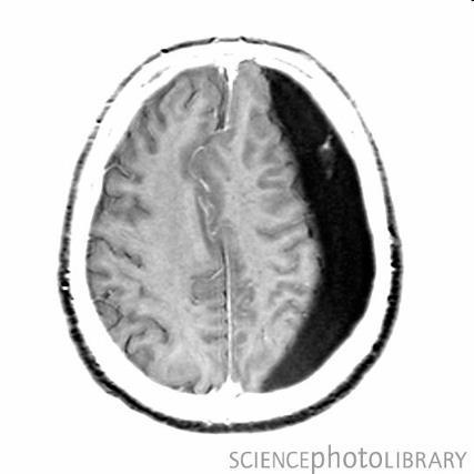 cerebri magna Galeni) vv. meningeae odpovídají tepnám vv.