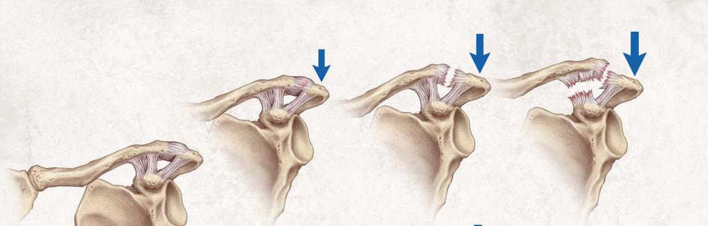 Akromioklavikulární poranění Poranění AC ligament- CC