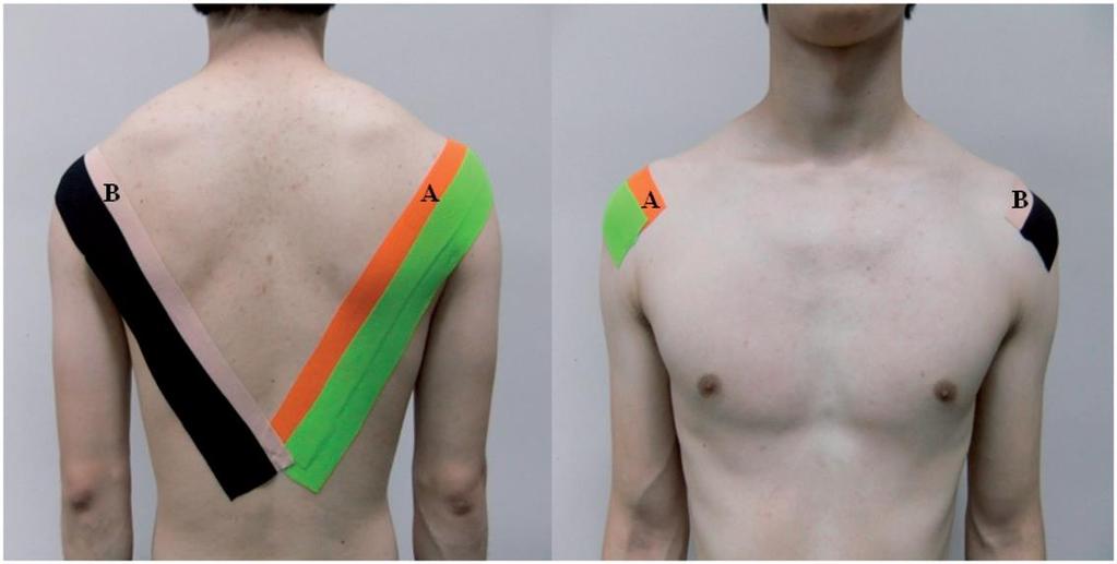 Obrázek 9: Aplikace kinesio tapu s napětím na jedno rameno (A) a bez napětí na druhé rameno (B) ve studii Jin-Tae et al.(2015) Hsu et al.