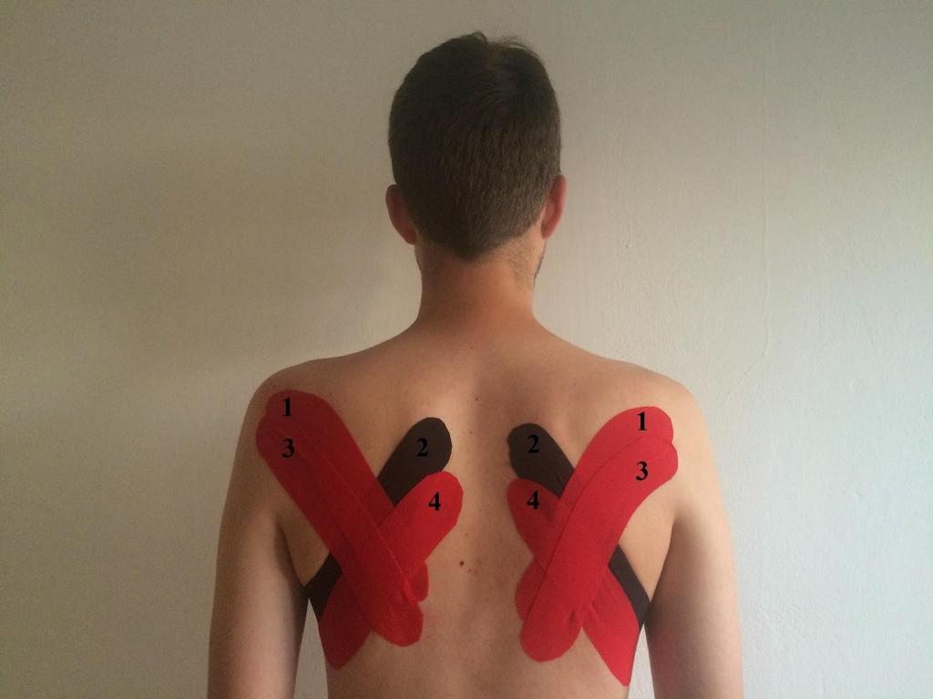 4.5. Průběh měření Obrázek 19: Facilitační kinesio taping dolních fixátorů lopatky Měření probíhalo ve standardizovaných podmínkách přizpůsobených pro daný účel.