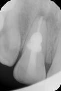 Nicméně pokud jsou využity spolu s technikou vertikální kondenzace za tepla nebo technikou centrálního čepu, jenž není záměrně zkrácen, tak při reendodontickém ošetření není oproti jiným sealerům