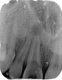 64 ODBORNÉ SDĚLENÍ LKS 3/2018 Obr. 4: Endodontické ošetření zubu 11 s neukončeným vývojem.
