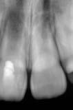 66 ODBORNÉ SDĚLENÍ LKS 3/2018 Obr. 7: Cervikální dyskolorace klinické korunky zubu 21 po aplikaci materiálu MTA při ošetření maturogenezí. Obr. 8: Maturogeneze zubu 11.