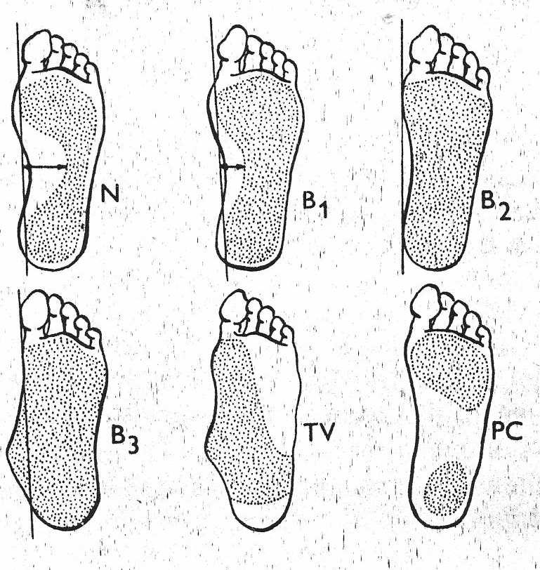 Plochou nohu můžeme rozdělit podle závažnosti nálezu na plantogramu (tj. otisku nohy ve stoje s viditelným rozložením zátěže) do tří stupňů: 1.