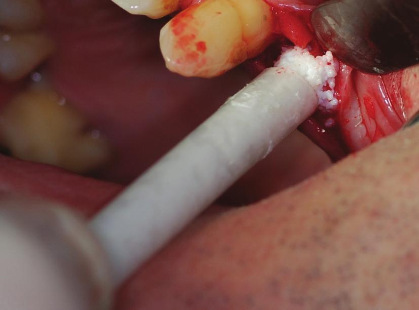 OsteoBiol mp3 vytlačený přímo z příruční stříkačky Zdroj: Laskavě zapůjčil dr.