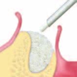 Klinické indikace Animovaná videa jsou dostupná zdarma v aplikaci OsteoBiol APP BIBLIOGRAFIE Náhrady kostí Patentovaný výrobní proces Tecnoss použitý k získání materiálu OsteoBiol je schopen