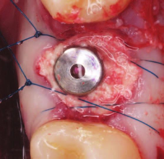 Periimplantátový defekt doplněný s použitím produktu OsteoBiol