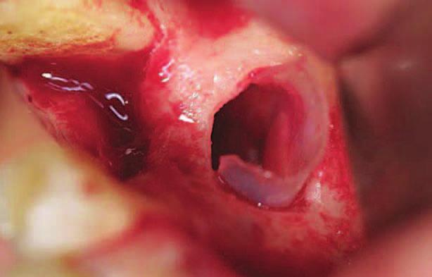 OsteoBiol Special chránící Schneiderovu membránu před augmentátem Zdroj: