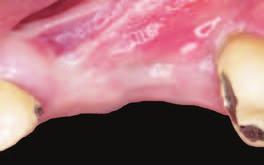 Apatos a Lamina a stehů s PP 5/0 Dried membrane covered with micronized bone