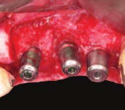 and bone granules Obr.