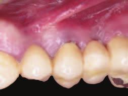 7 Zavedení kortikální laminy OsteoBiol Cortical Tissue Lamina, collagenaby bylo