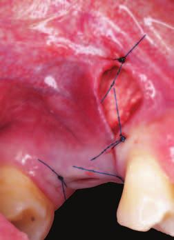 2 Zavedení implantátů, kde je možno pozorovat fenestrační defekt