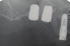 SINUS LIFT KRESTÁLNÍM PŘÍSTUPEM Zpráva o