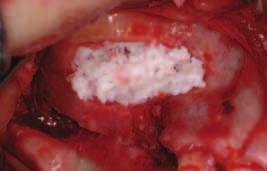 SINUS LIFT LATERÁLNÍM PŘÍSTUPEM Zpráva o případu Sinus lift