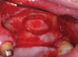3 Provedena osteotomie pro získání přístupu k pravému maxilárnímu