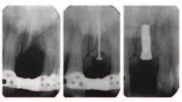 9 Zavedení implantátu Brånemark NP Obr.