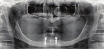 8 Zavedení dvou implantátů (oblast 42, 32).