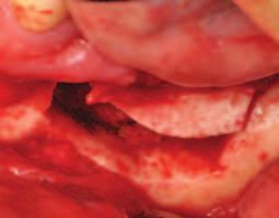 implantátu Obr. 11-12 Histologický detail*.