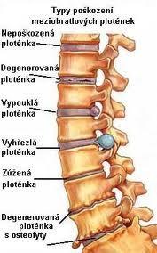 Onemocnění páteře Cervikální degenerativní syndromy-cc a CB,cervikokardiální a cervikogastrický Krční myelopatie,syndrom zadního