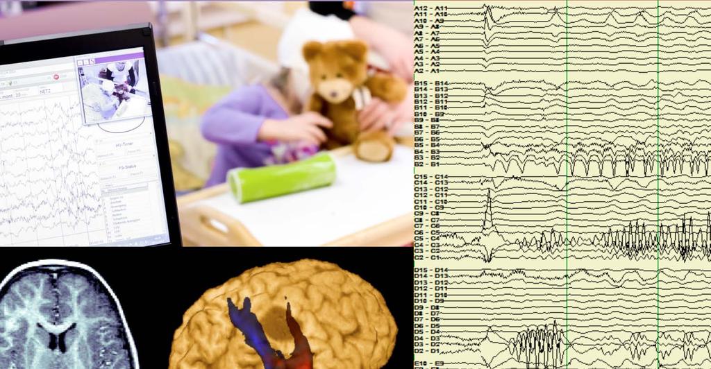 Síť ERN pro epilepsie (EpiCARE) Epilepsie v Evropě postihuje nejméně 6 milionů lidí. Tradiční antiepileptické terapie pomáhají 60 až 70 % osob k tomu, že mohou žít bez záchvatů.