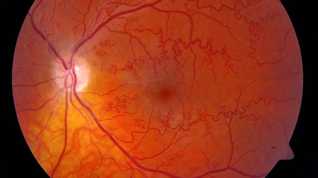 Síť ERN pro oční onemocnění (ERN EYE) 20 Vzácná oční onemocnění jsou v Evropě hlavní příčinou vad zraku a slepoty u dětí a mladých dospělých.