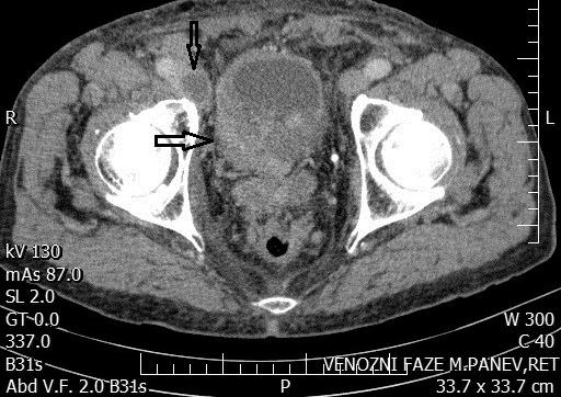 317 Obr. 2b. CT venózní fáze, trans verzální řez: nehomogenní infiltrát periprostaticky, v sousedství centrálně nekrotická patologická lymfatická uzlina Fig. 2b. CT scan venous phase: non homogeneous infiltrates around the prostate, adjacent to the central necrotic pathological lymph node metastatická ložiska jater.
