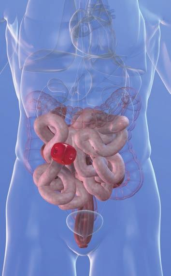 Co je ileostomie? Existují tři typy vývodů: kolostomie, ileostomie a urostomie.