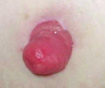 Co je ileostomie? Aby byl umožněn odchod stolice z těla, vytvoří chirurg na vnější straně pacientova břicha malý otvor, kterým vyvede konec tenkého střeva a stehy ho fixuje ke kůži.