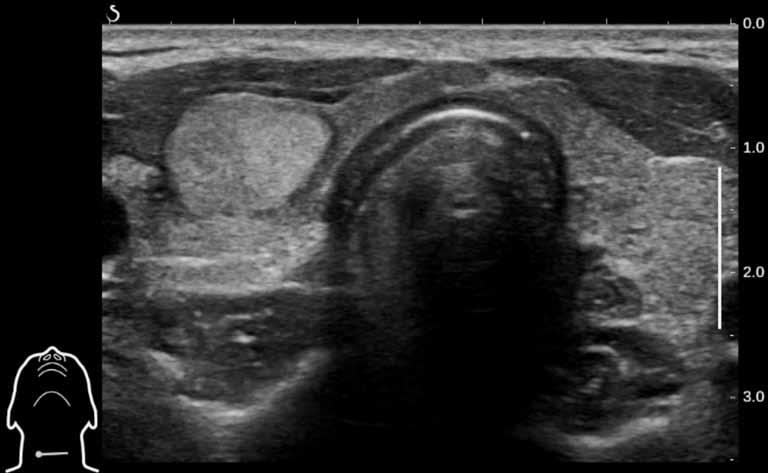 Obr. 2 Obr. 2. Uzel v pravém laloku štítné žlázy s anechogenním okrajem (halo), homogenní, s pravidelnými okraji, vyšší vaskularizace. Kvůli velikosti (16 16 12 mm) byla indikována FNAC.
