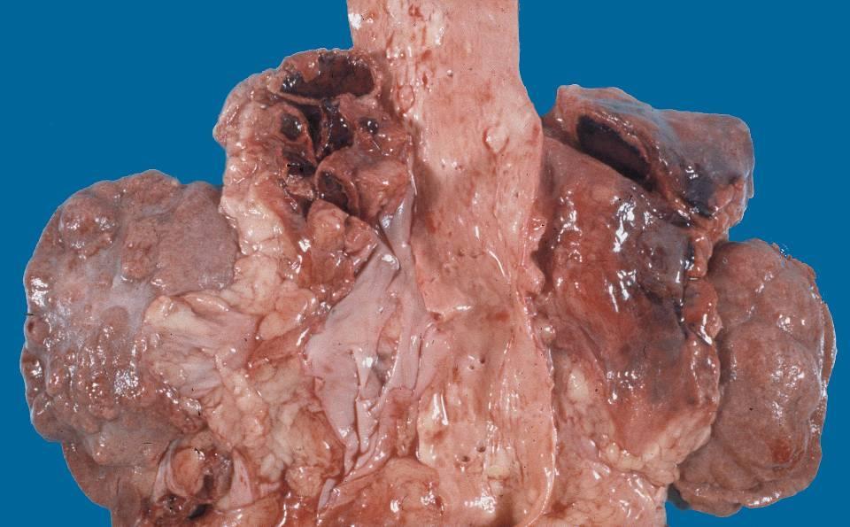 Haemorrhagia