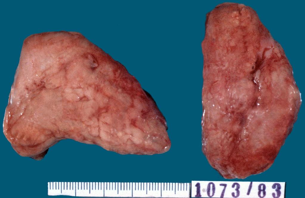 Hyperplasia gl.