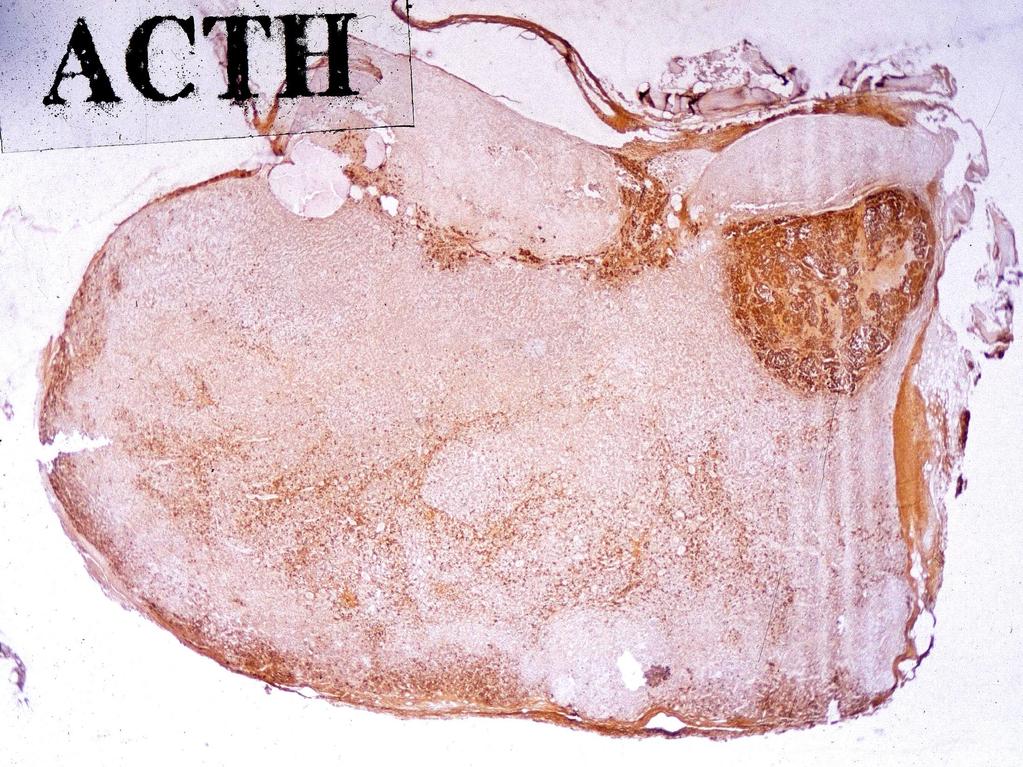 ACTH