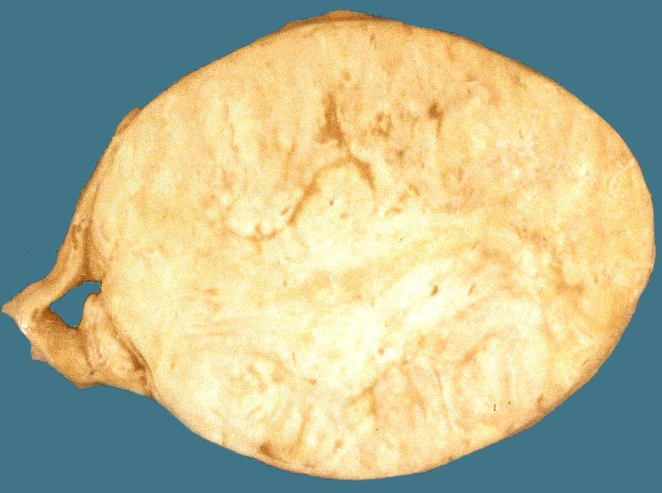 Adenoma gl.