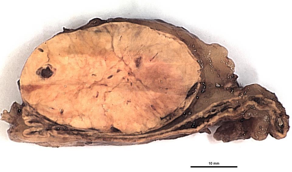 Adenoma