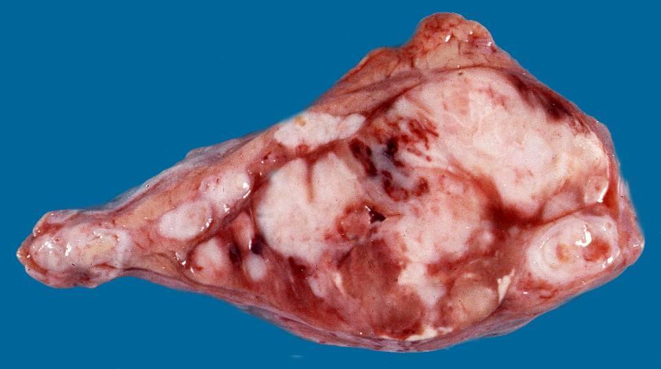 Metastases ca pulmonum