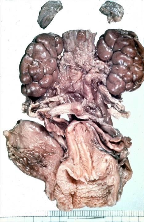 Hypoplasia