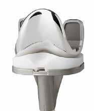 Zimmer představuje možnost implantace totální náhrady kolenního kloubu pomocí individuálních řezacích šablon V centimetrech Other primary knee implants 1 Zimmer NexGen Knee 3 2005 2006 2007