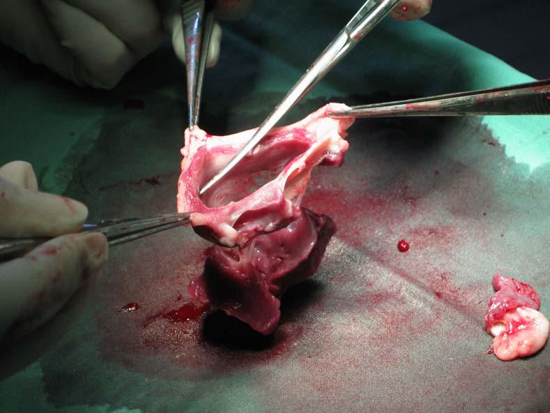 Obr. 3: Preparace mitrálního alograftu I. - explantace mitrální chlopně včetně závěsného aparátu a obou papilárních svalů.