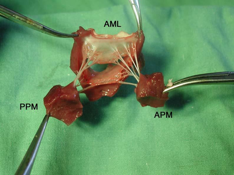 10: Implantace MA do trikuspidální polohy operační postup I. - Kanyly mimotělního oběhu.