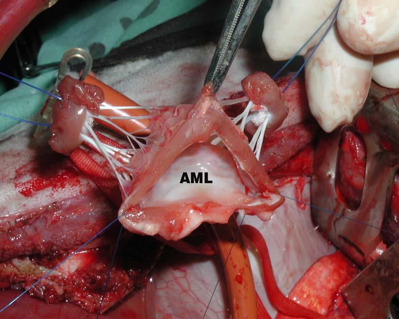 Obr. 13: Implantace MA do trikuspidální polohy operační postup III.