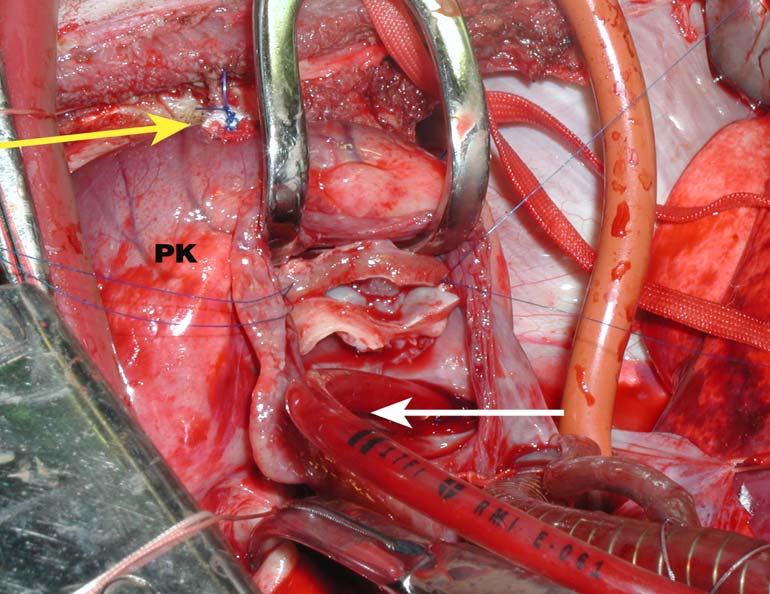 Obr. 15: Implantace MA do trikuspidální polohy operační postup V. - Implantace mitrálního alograftu.