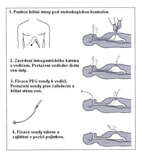 Perkutánní