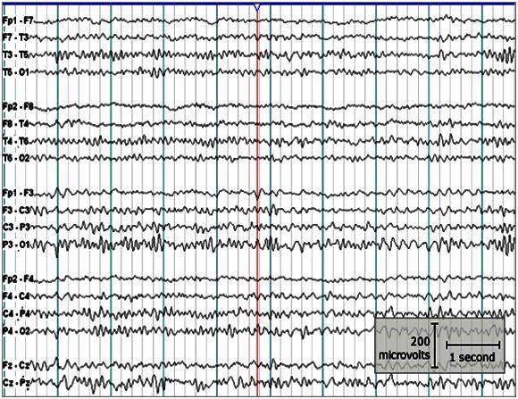 Ukázka záznamu EEG je vyobrazena na obr. 2.1. Obrázek 2.1: Příklad 18-ti kanálového záznamu EEG [20] 2.
