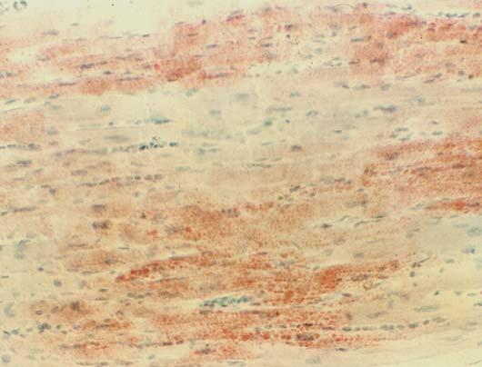 steatosa