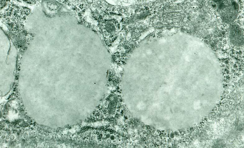 hyperlipoproteinemie.