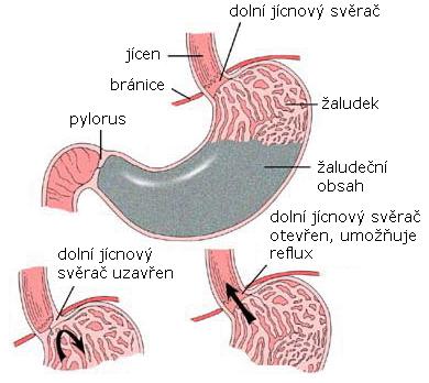 Gastroezofageální reflux retrográdní posun žaludečního obsahu do jícnu kde působí agresivně HCl, enzymy proteázy (pepsin) event.