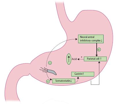 H. pylori pozitivní vřed duodena narušení spojení antrum-fundus normálně snížení produkce HCl při infekci H.